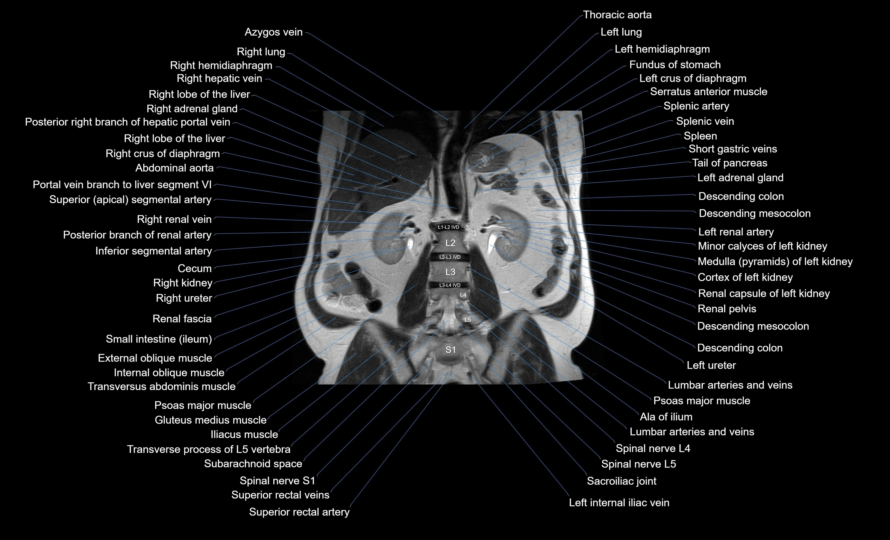 MRI Abdomen coronal labelled cross sectional anatomy radiology  image-img-00001-00037.webp